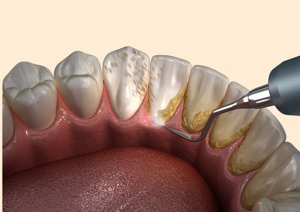 Scaling & Dental Spa